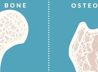 L’ostéoporose.